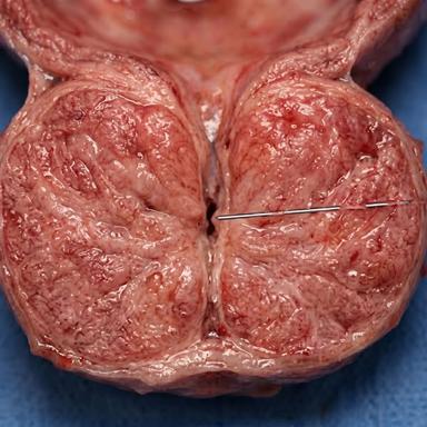 Men Health Expert - Jonathan Facebook ad: Save your own prostate.