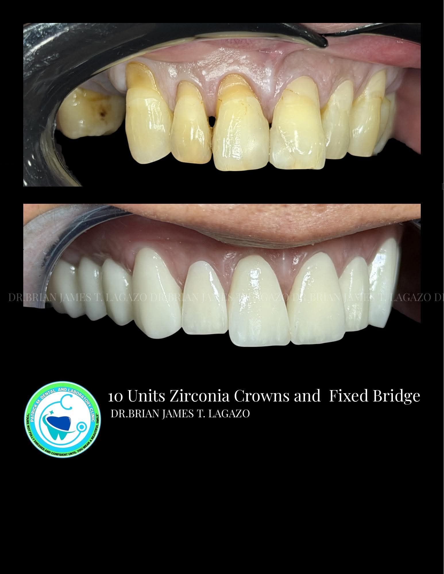 PMDCaL Malolos Facebook ad: Zirconia Crowns and Zirconia Fixbridge