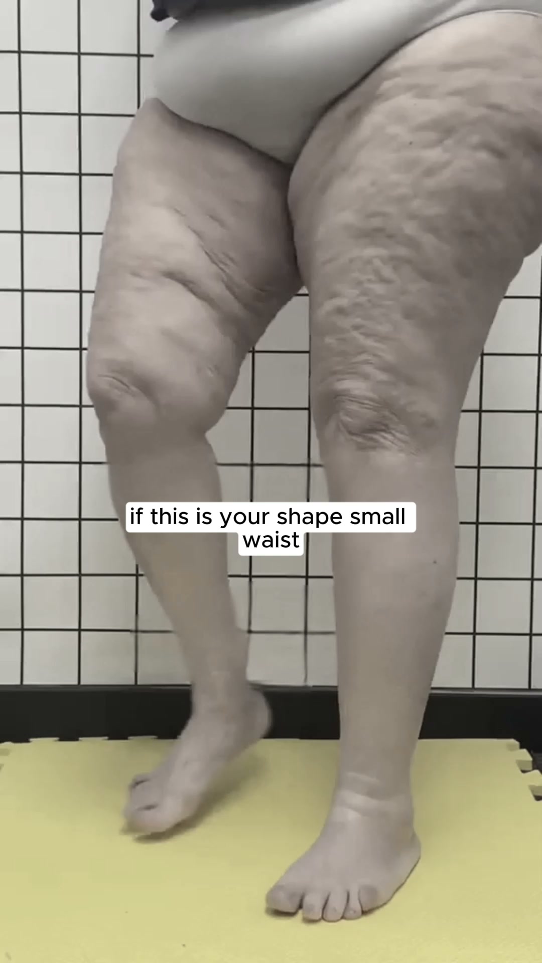 Cellumove- Facebook ad: Start your Lipedema Relief Today!