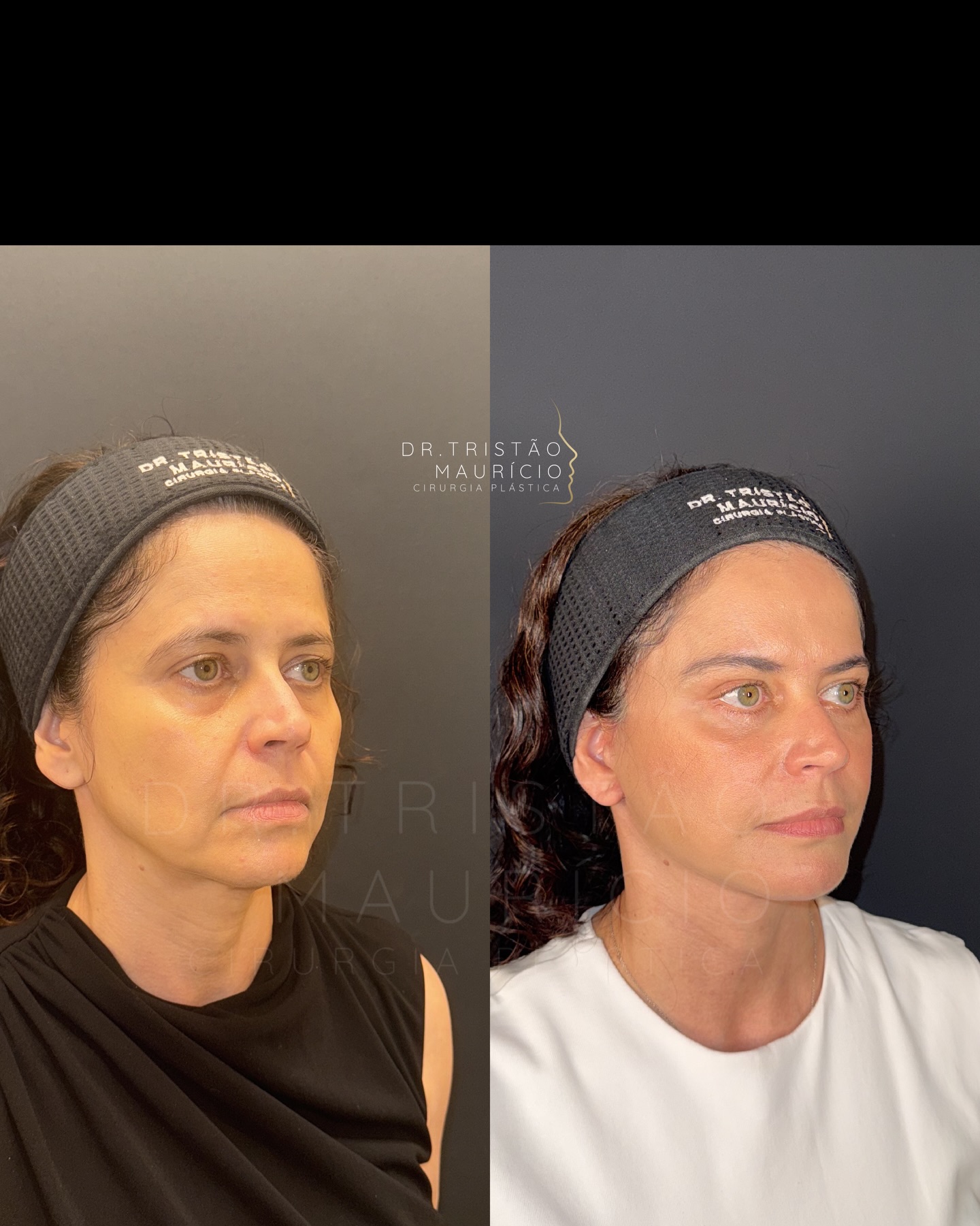 Dr. Tristao Mauricio Facebook ad: 49 anos e 3 meses de pós operatório.