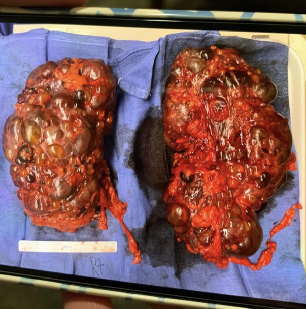 CleanBody Co. Facebook ad: His nephrologist couldn't explain the labs