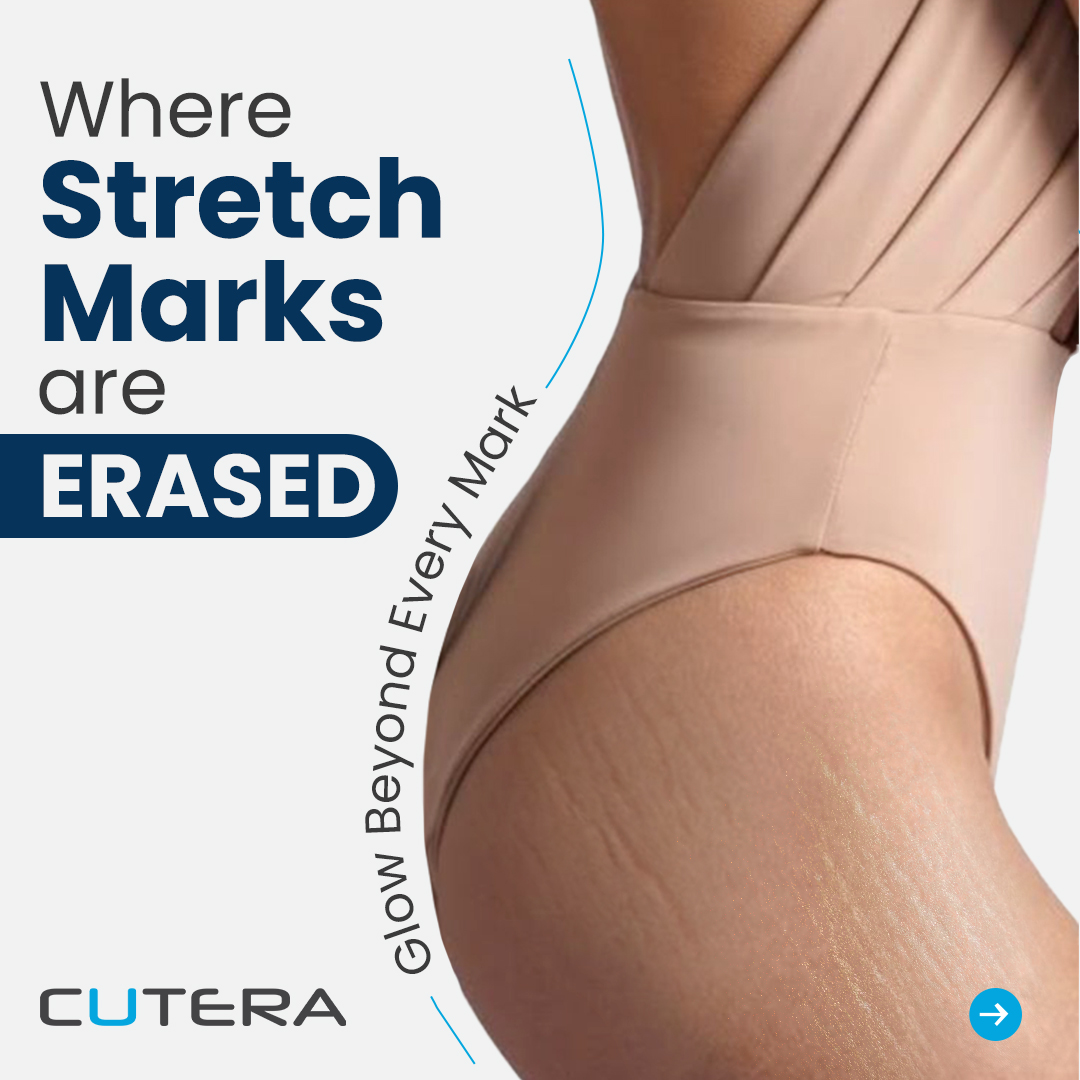 Cutera Aesthetics Facebook ad: Stretch marks aren’t just lines, they’re reminders of…