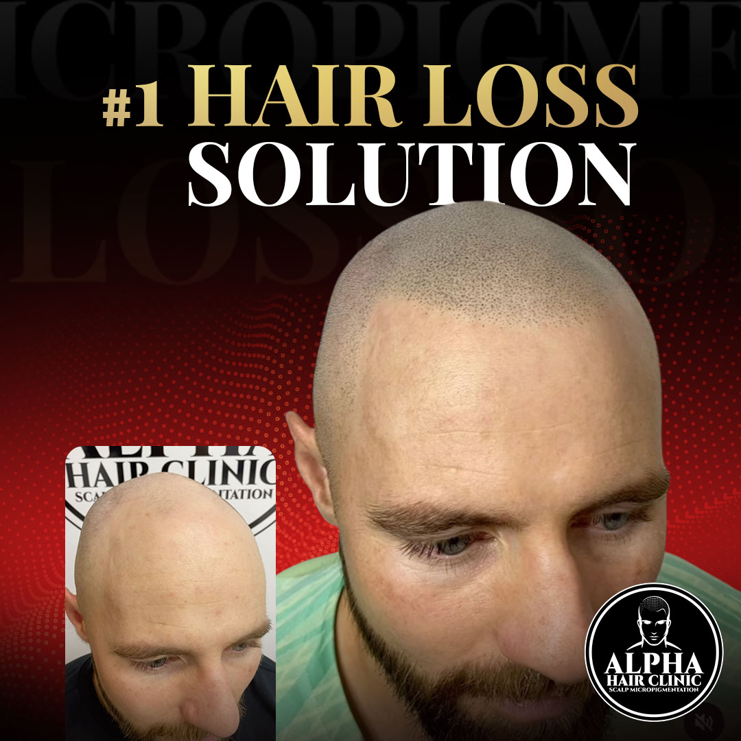 Alpha Hair Clinic Facebook ad: QLD Area, 15% Off Scalp Micropigmentation