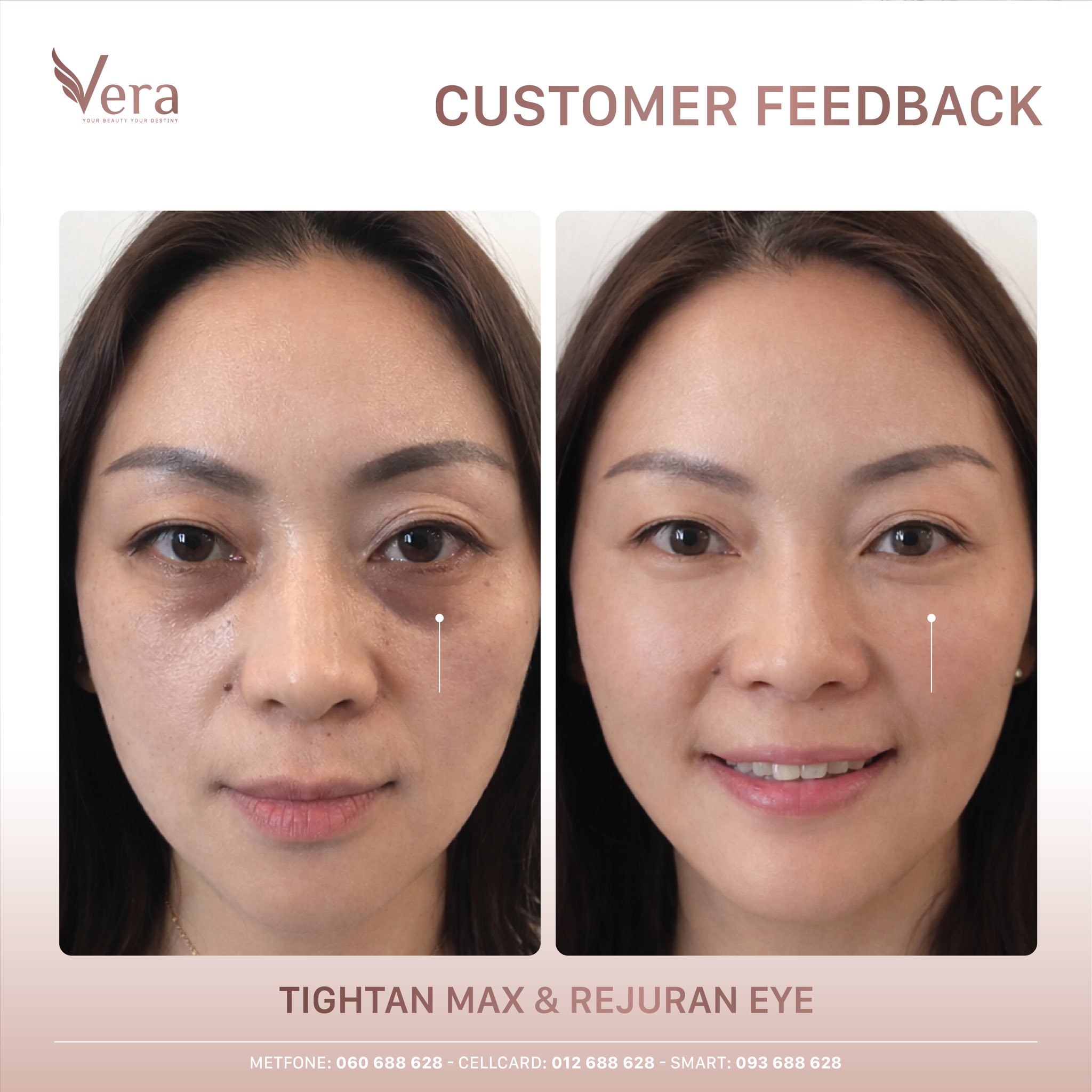 Vera Beauty ថែរក្សាសម្ភស្ស Facebook ad: Meso ភ្នែក- ដំណោះស្រាយ បន្ទាន់ សម្រាប់ស្នាមខ្មៅ…
