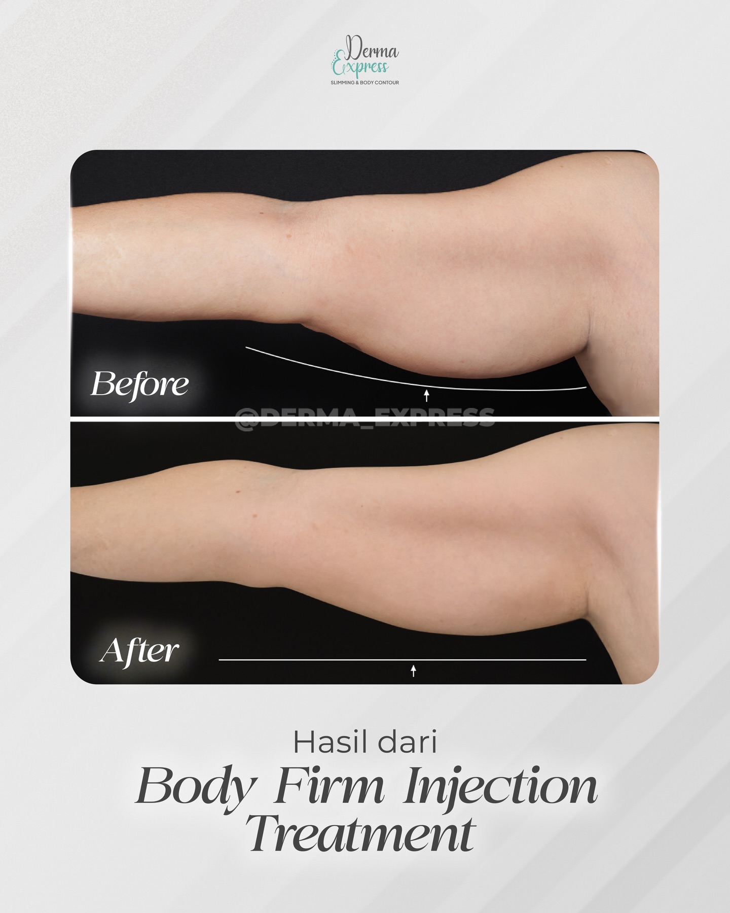 Derma Express Slim Facebook ad: Before dan after dari Body Firm Injection di…