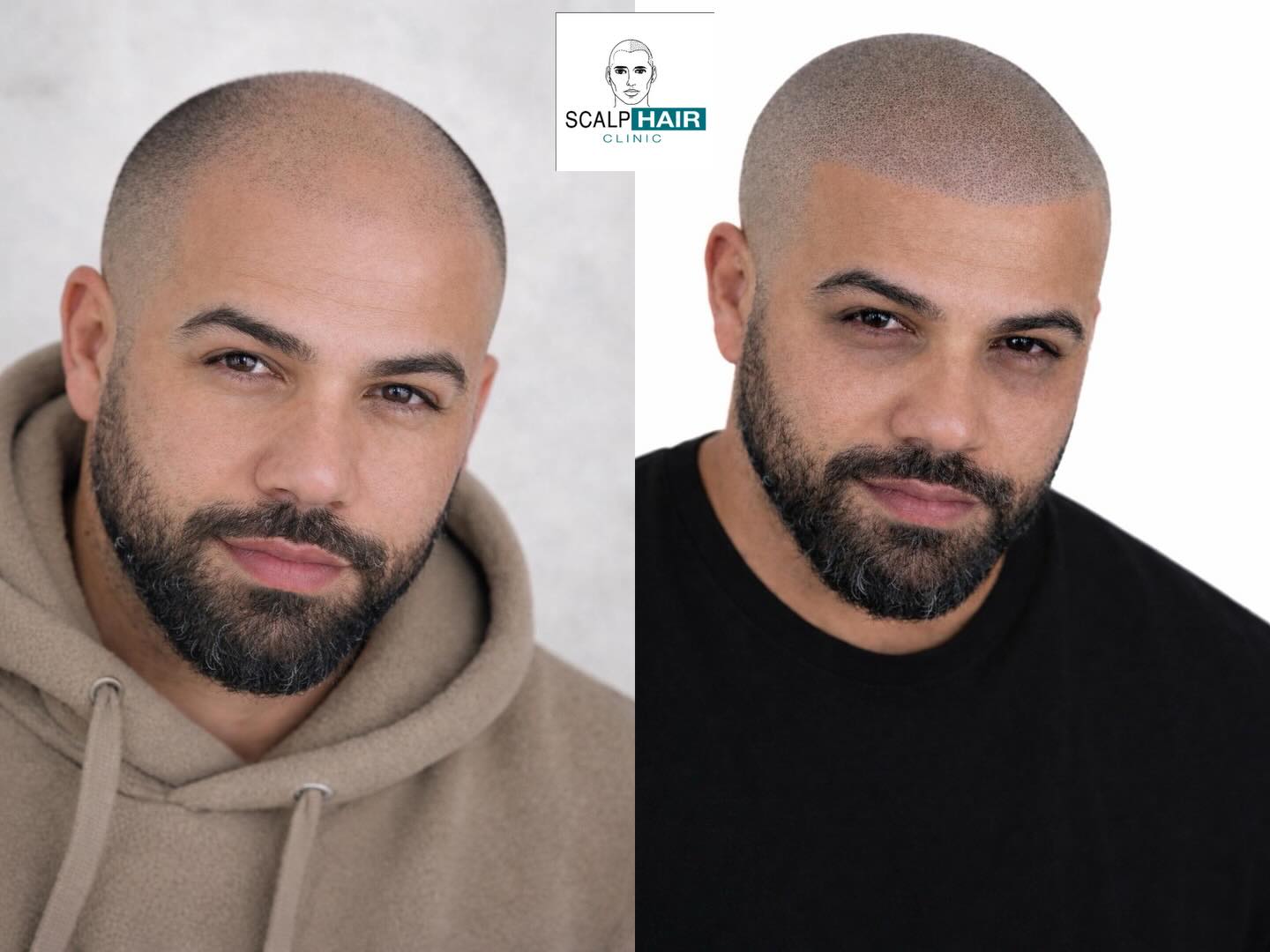 Scalp-Hair Clinic Facebook ad