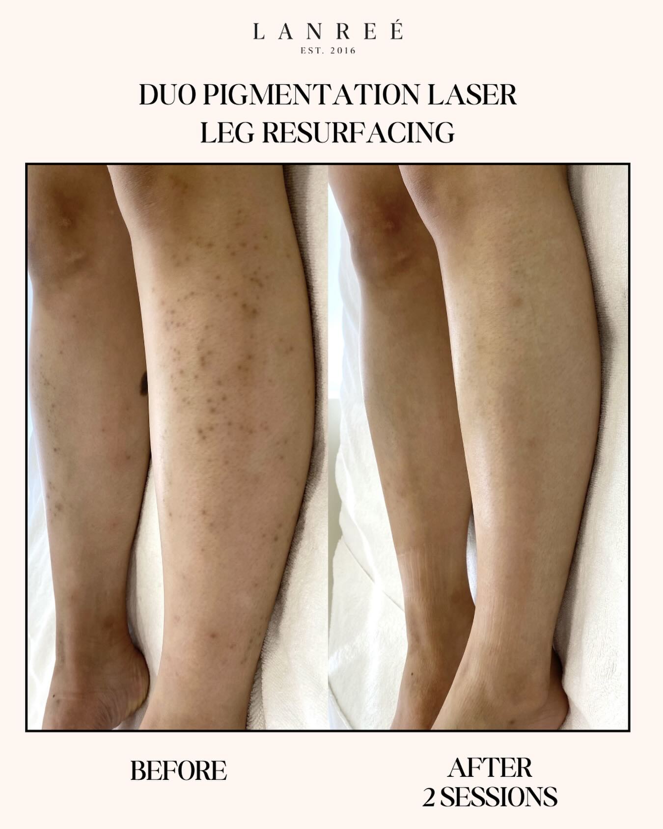 Lanree Aesthetics Facebook ad: Full-Body Laser Rejuvenation | Piqo4 + Fotona MaQX