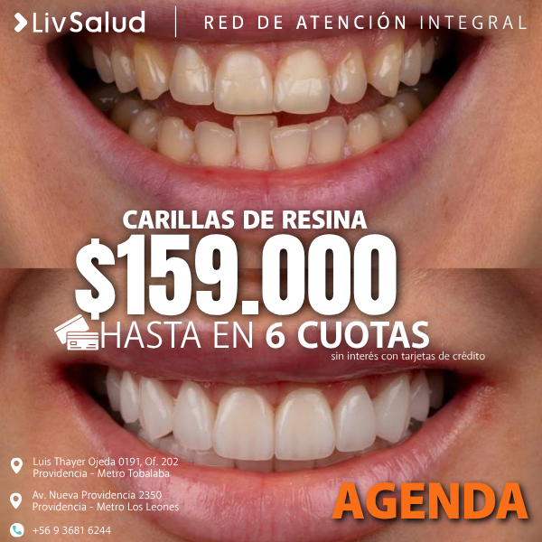 LivSaludcl Facebook ad: Carillas de Resina $159.000
