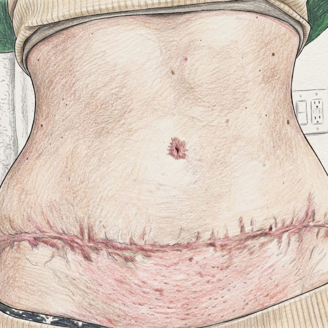 TryVetra Facebook ad: If you have a tummy tuck scar read this