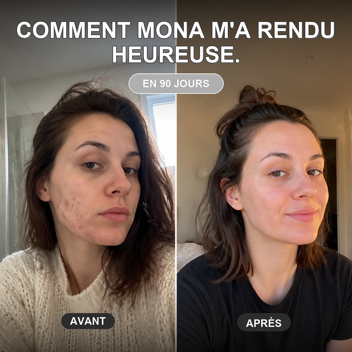Mona Ritual Facebook ad: L'acné hormonale a sa cure.