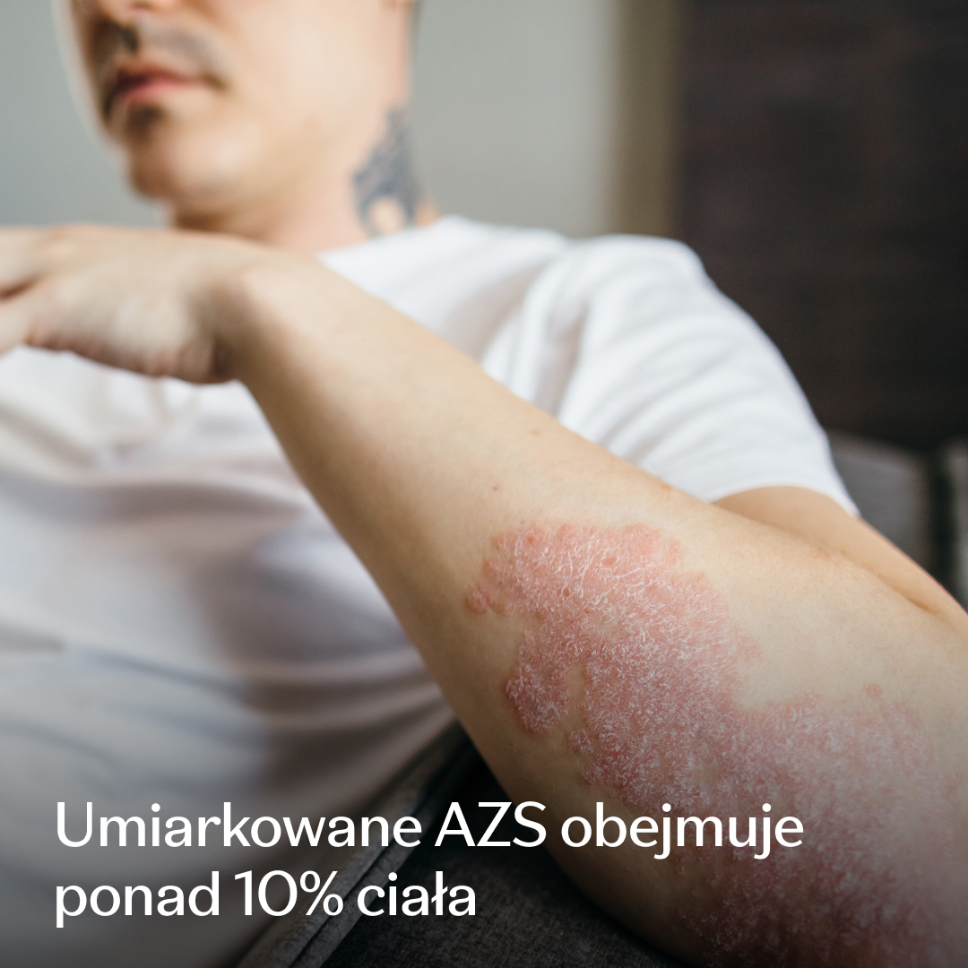 Eczema Research Study Facebook ad: Badanie kliniczne dotyczące umiarkowanego AZS