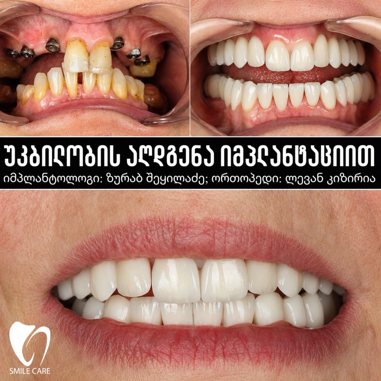 Smilecare საერთაშორისო სტომატოლოგიური ცენტრი Facebook ad: ნებისმიერი სირთულის იმპლანტაცია მარტივად…