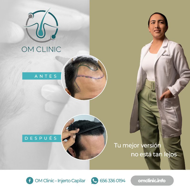 OM Clinic - Injerto Capilar Facebook ad: ¿Notas que tu cabello ya no es el…