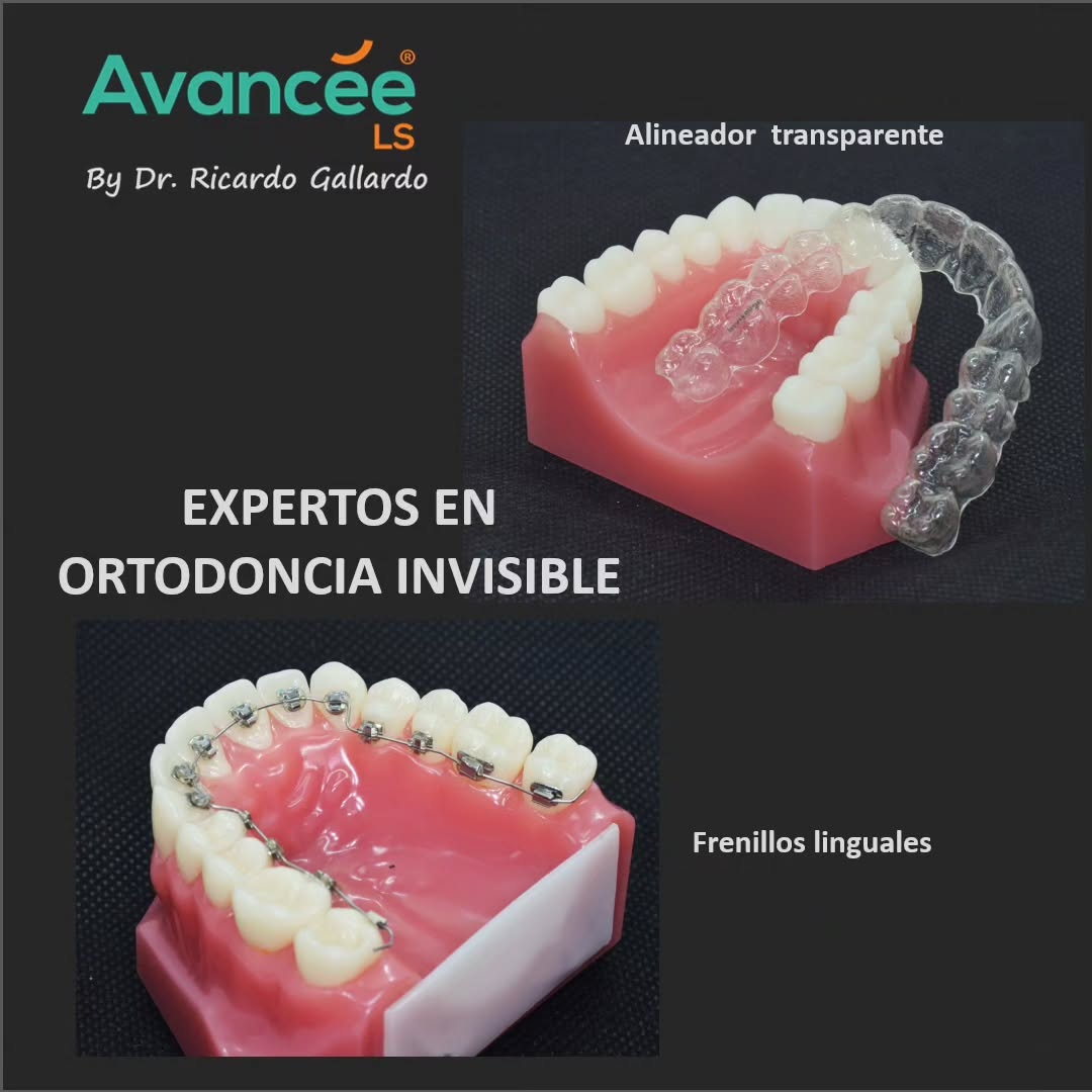 Avancée Ortodoncia Lingual Facebook ad: La ortodoncia invisible es la mejor opción si…