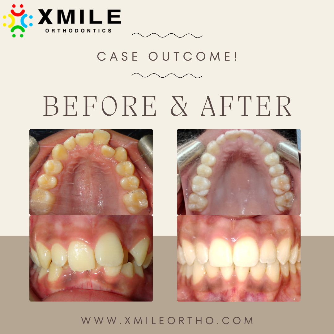 Xmile Orthodontics Facebook ad: BEFORE & AFTER/ ANTES & DESPUÉS Dr.