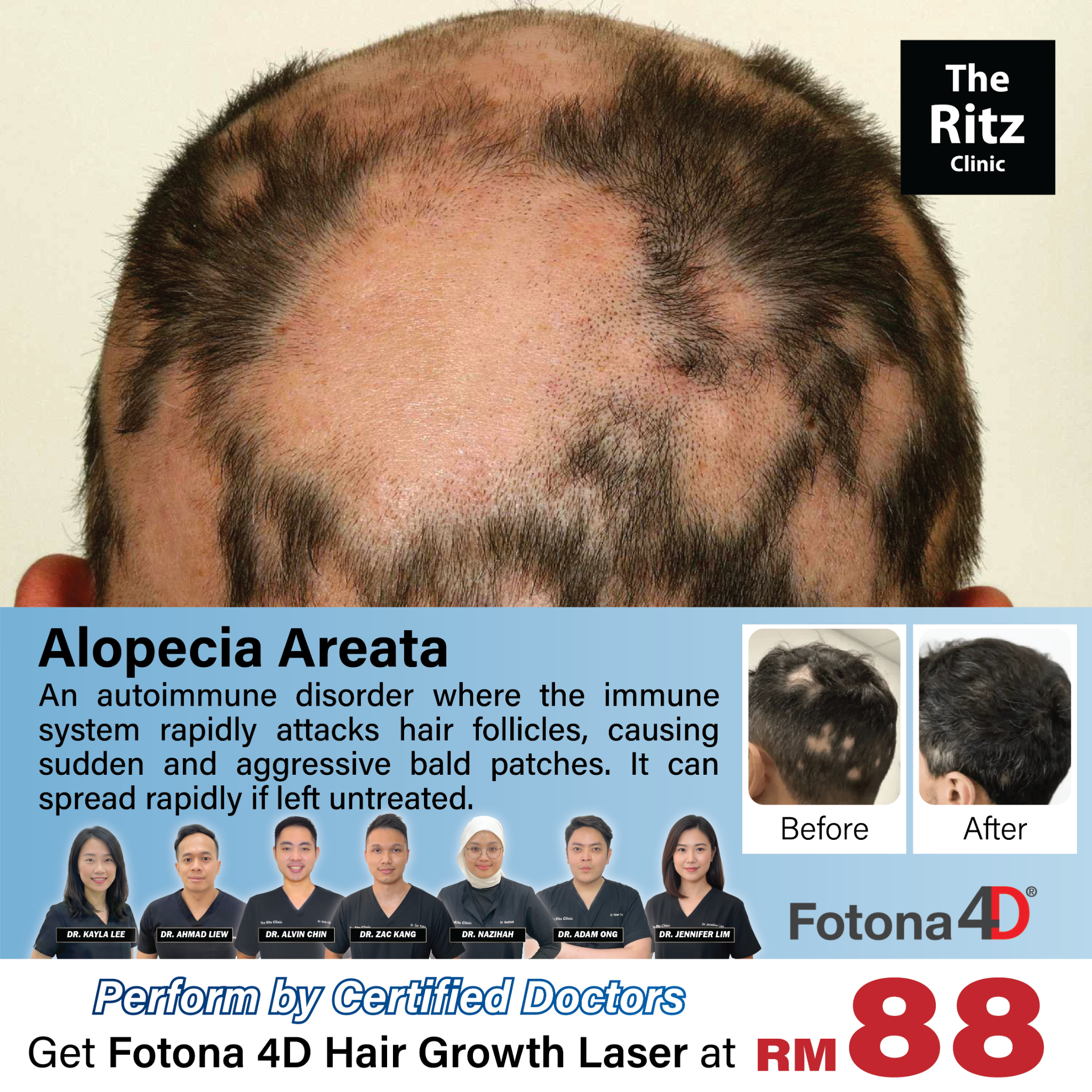 The Ritz Clinic - LCP Certified Facebook ad: 𝐅𝐨𝐭𝐨𝐧𝐚 𝟒𝐃 𝐇𝐚𝐢𝐫 𝐆𝐫𝐨𝐰𝐭𝐡 𝐋𝐚𝐬𝐞𝐫 at…