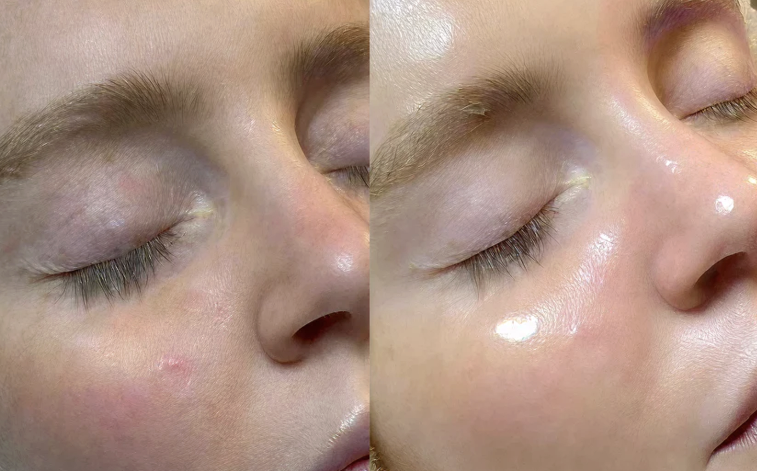 Skin Solution MedSpa Facebook ad: Hydrating Facial Winter Sale