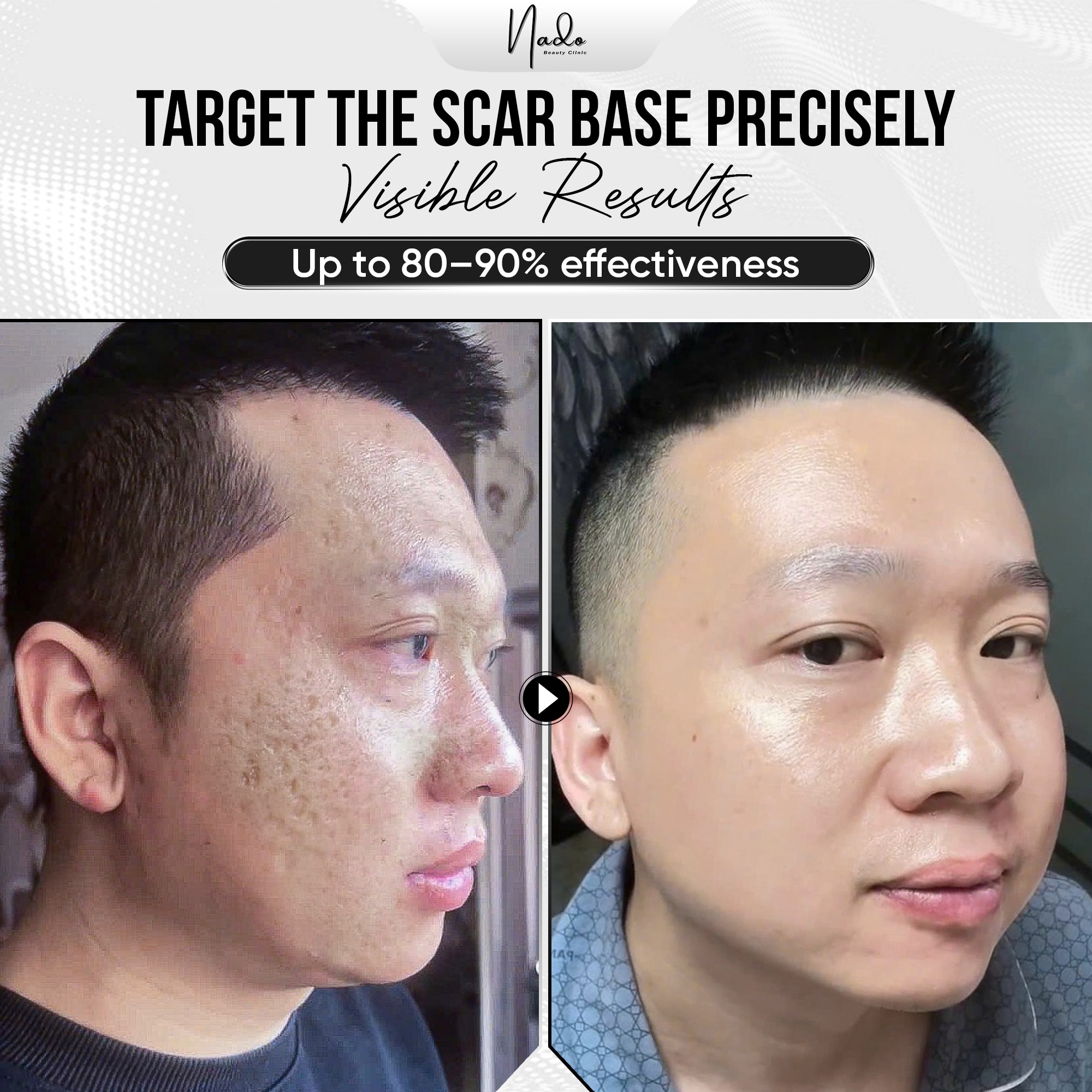 Nado Clinic Facebook ad: PITTED SCARS DON’T GO AWAY ON THEIR OWN.
