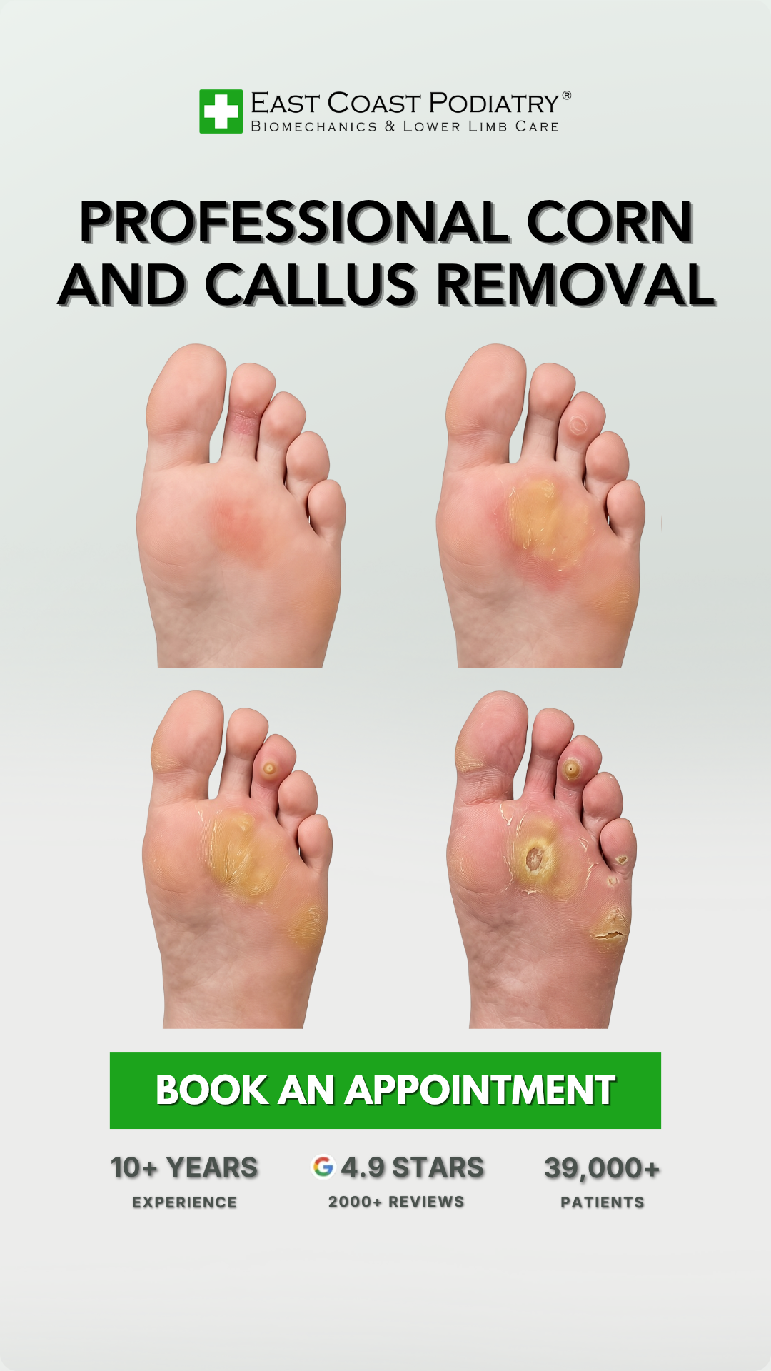 East Coast Podiatry Facebook ad: Professional Clinical Treatment for Corns and Calluses