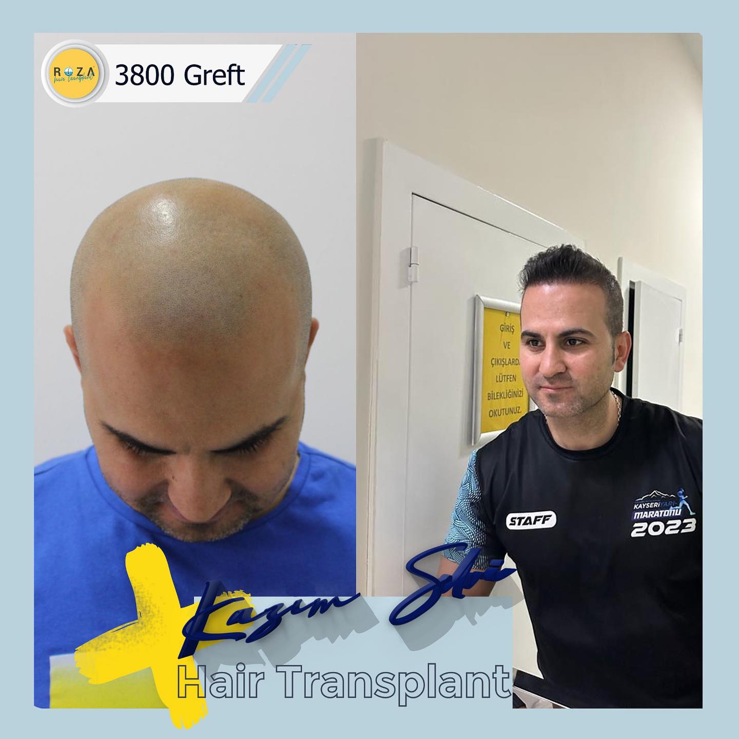 Roza Hair Transplant Facebook ad: ROZA Kayseri saç ekimi ile doğal ve kalıcı…