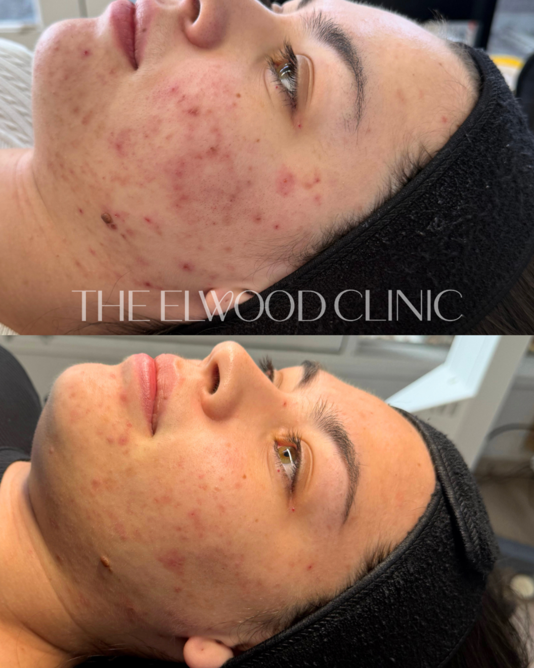 The Elwood Clinic Facebook ad: Acne treatment shouldn't be guesswork.