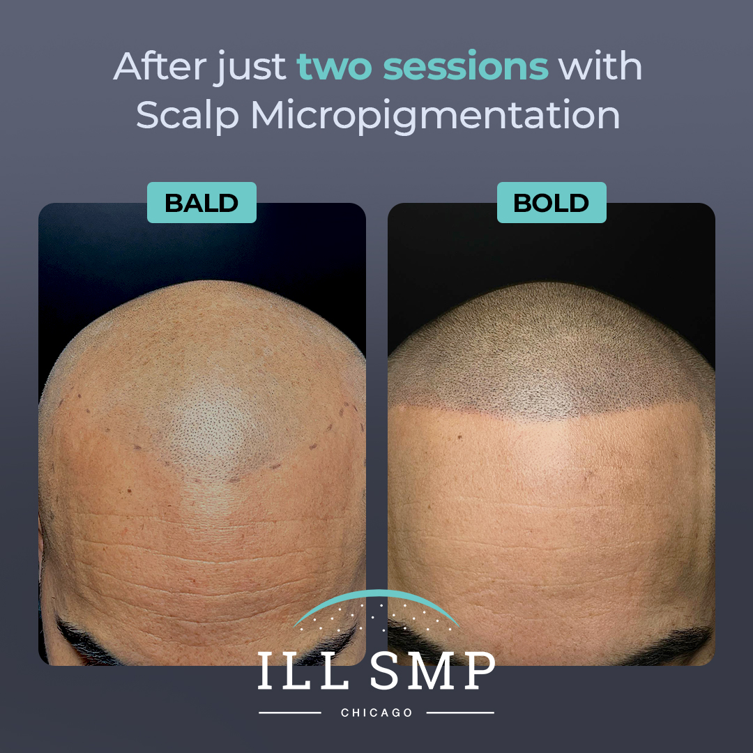 ILL SMP Chicago Facebook ad: Illinois, 15% Off Scalp Micropigmentation