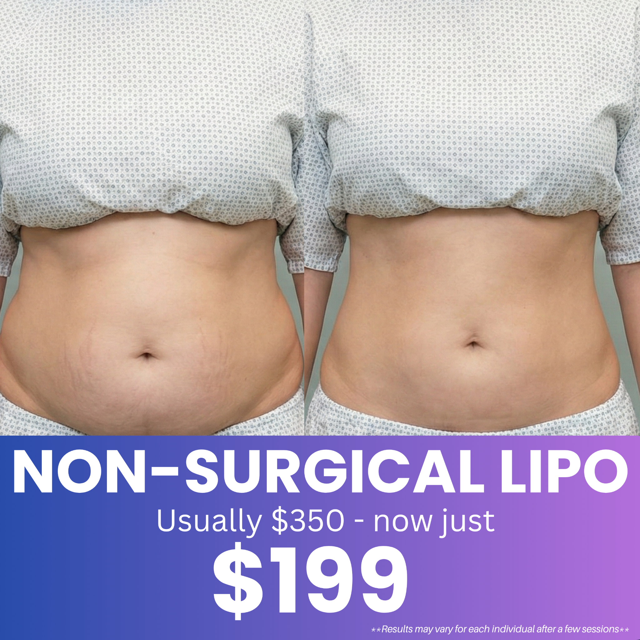 Modern Cryo & Wellness Facebook ad: Non Surgical Lipo for Only $199!