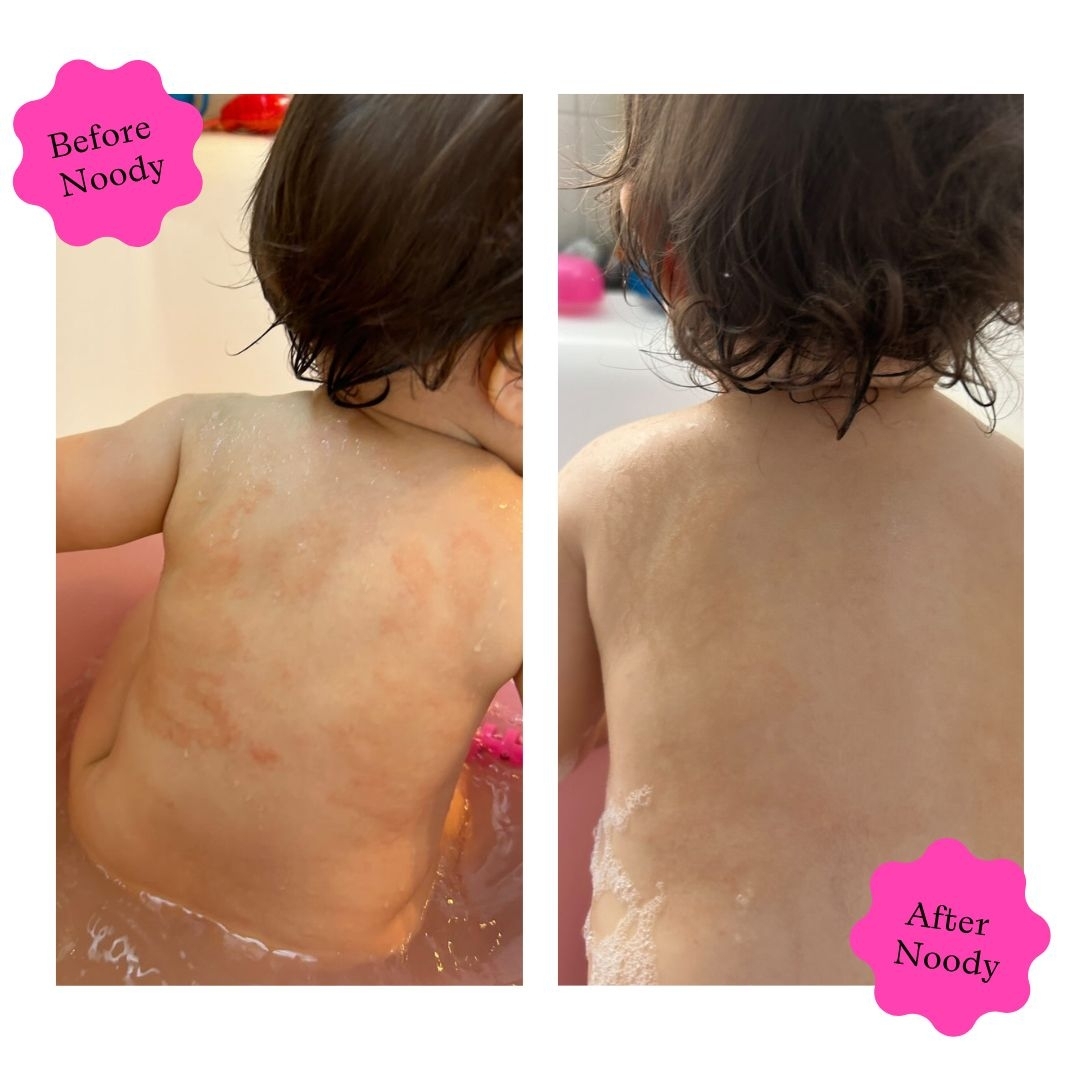 Noody Skincare Facebook ad: These incredible results are from just one week…