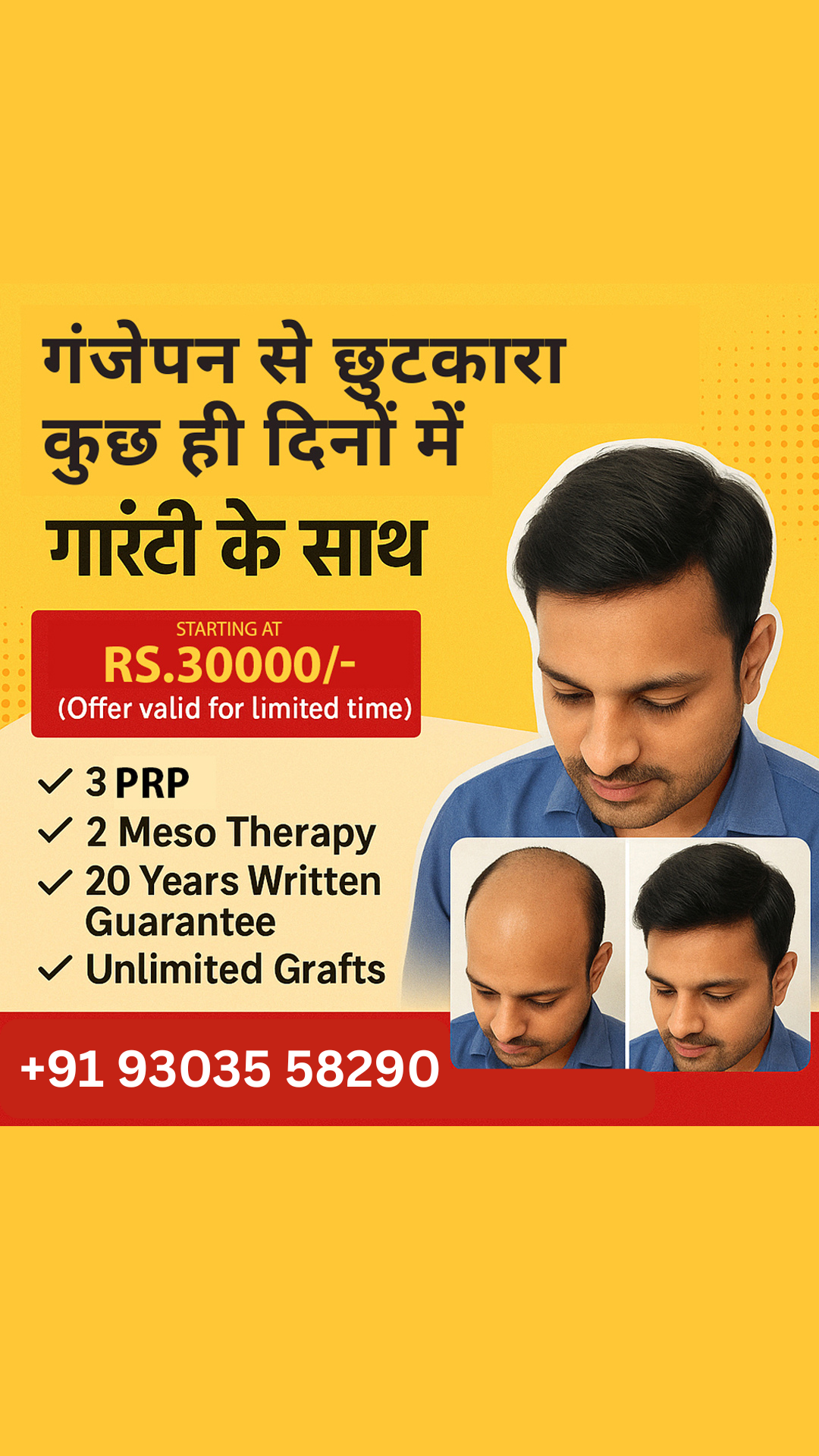 Best hair Transplant in Rajsthan-Udaypur-Kota,Jodhpur,Jaipur Facebook ad