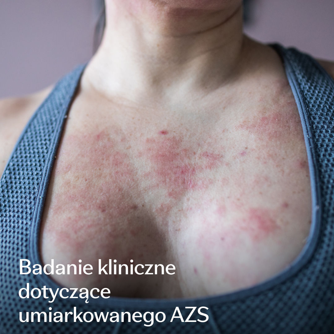 Eczema Research Study Facebook ad: Badania nad umiarkowanym AZS