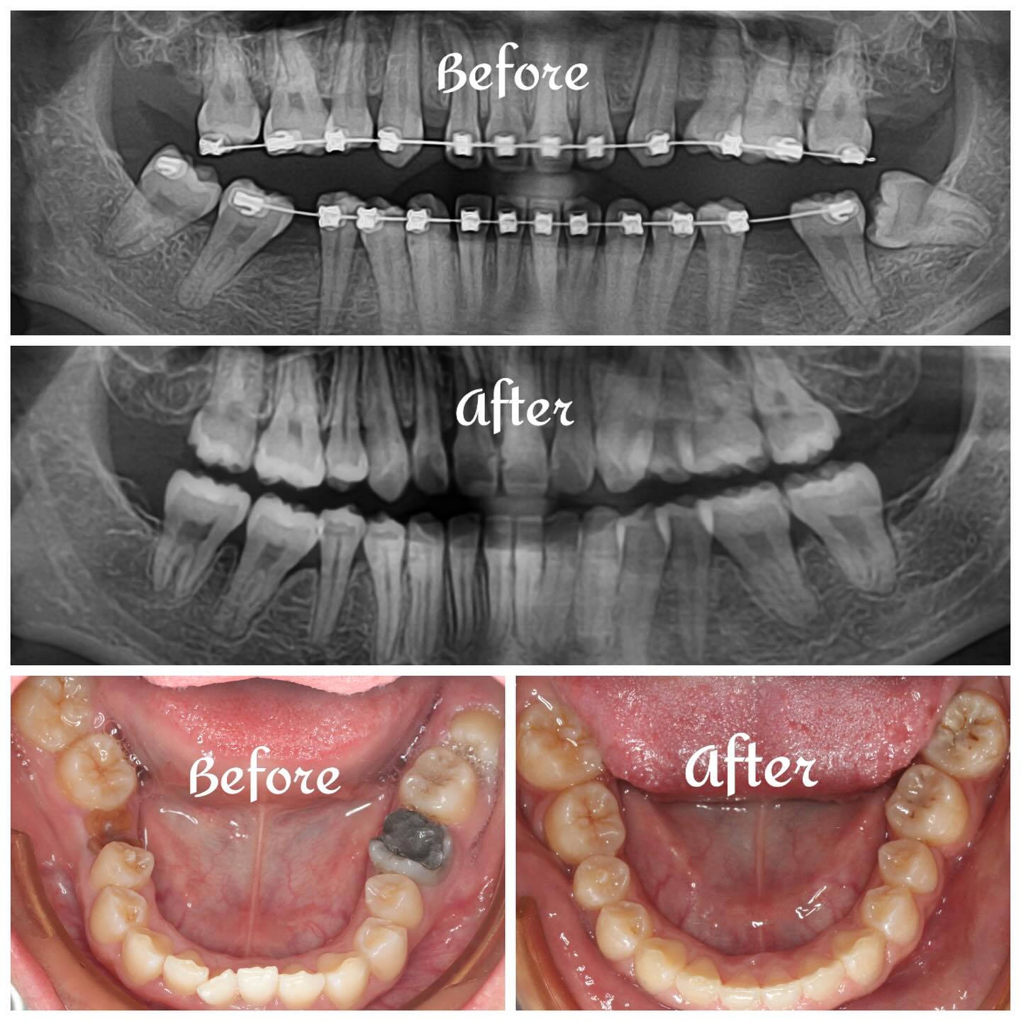 鍾思遠 齒顎矯正醫師 Facebook ad: Extract the upper premolars and compromised lower molars…