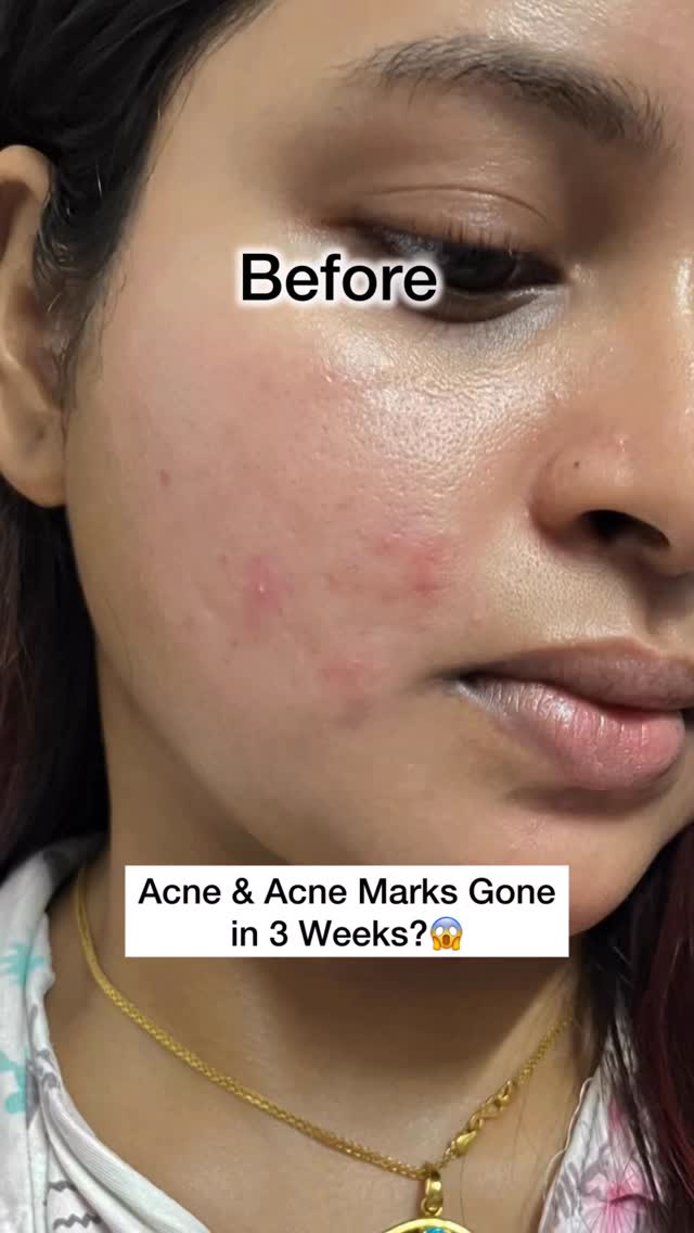 Plix Facebook ad: Save For Later & Comment Acne for link