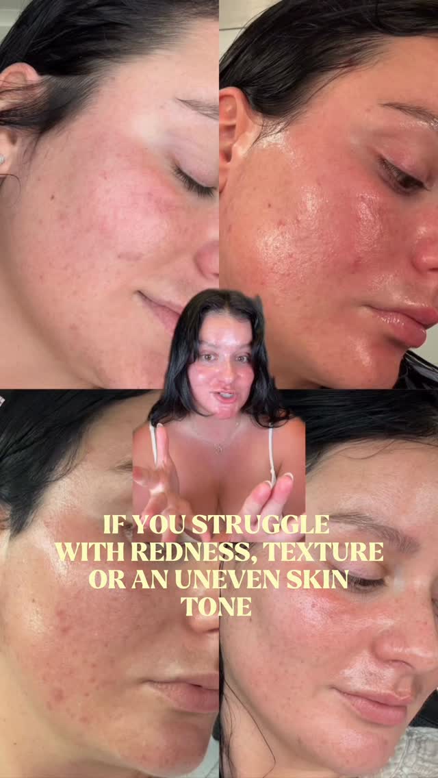 The Ordinary Facebook ad: azelaic acid is having a MOMENT and it…