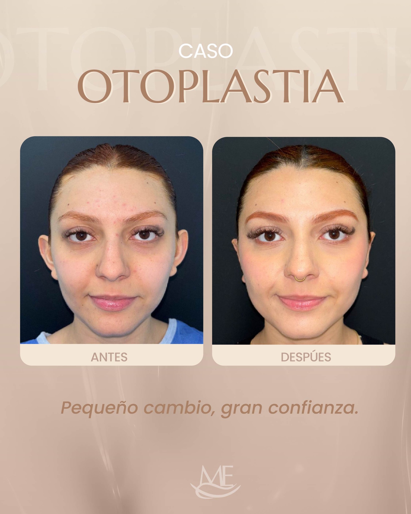 Medicina Estética Costa Rica Facebook ad: La otoplastia corrige la forma, tamaño y apertura…