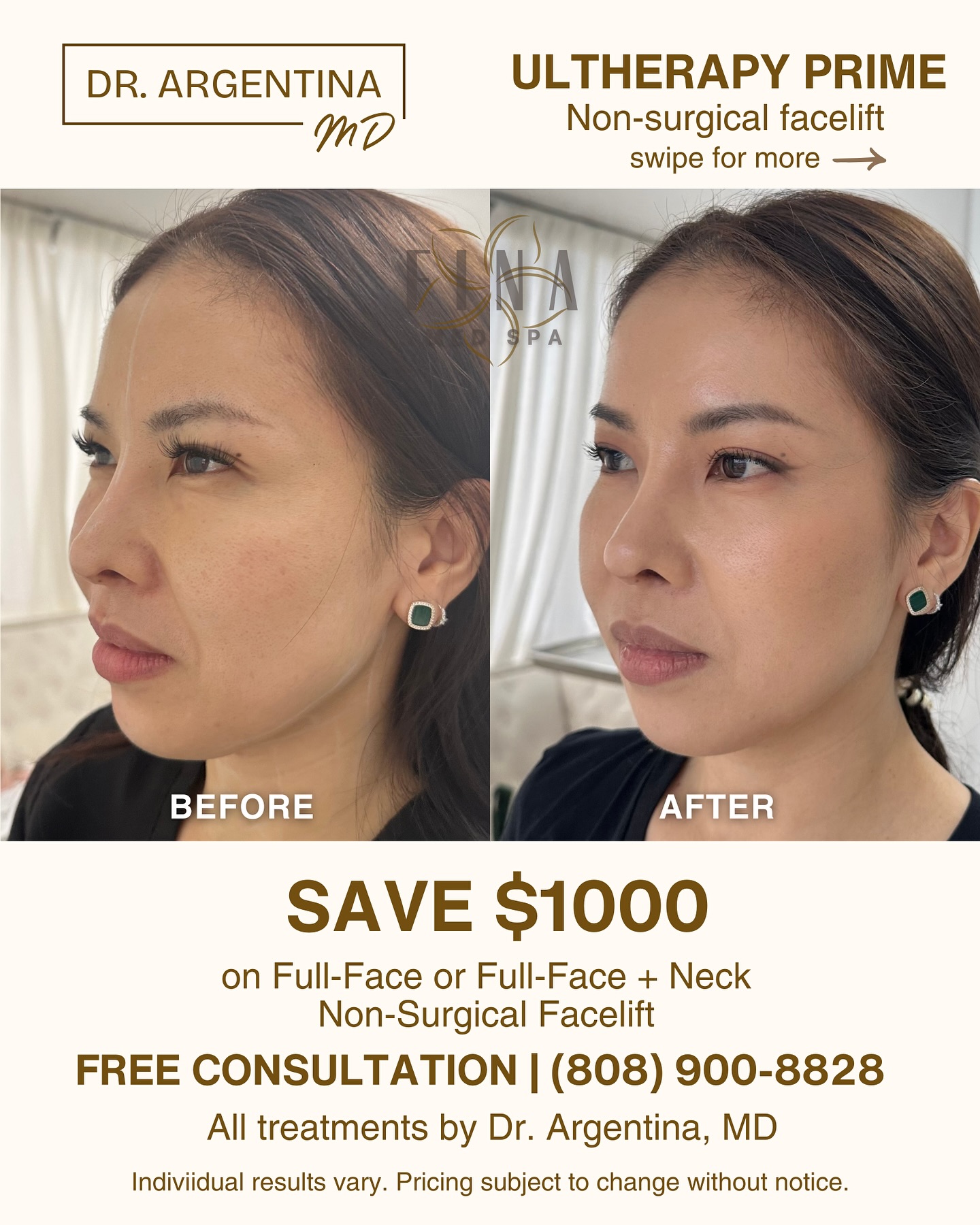FINA MedSpa Facebook ad: SAVE $1,000 ON ULTHERAPY PRIME