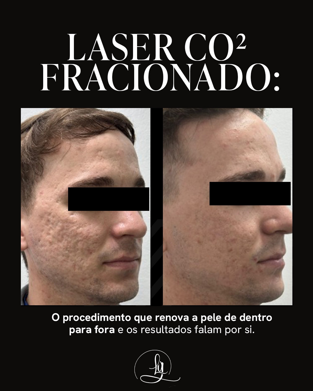 Dra. Laís Giovanoni - Dermatologia Facebook ad: Tem um procedimento que trata textura, manchas, poros…