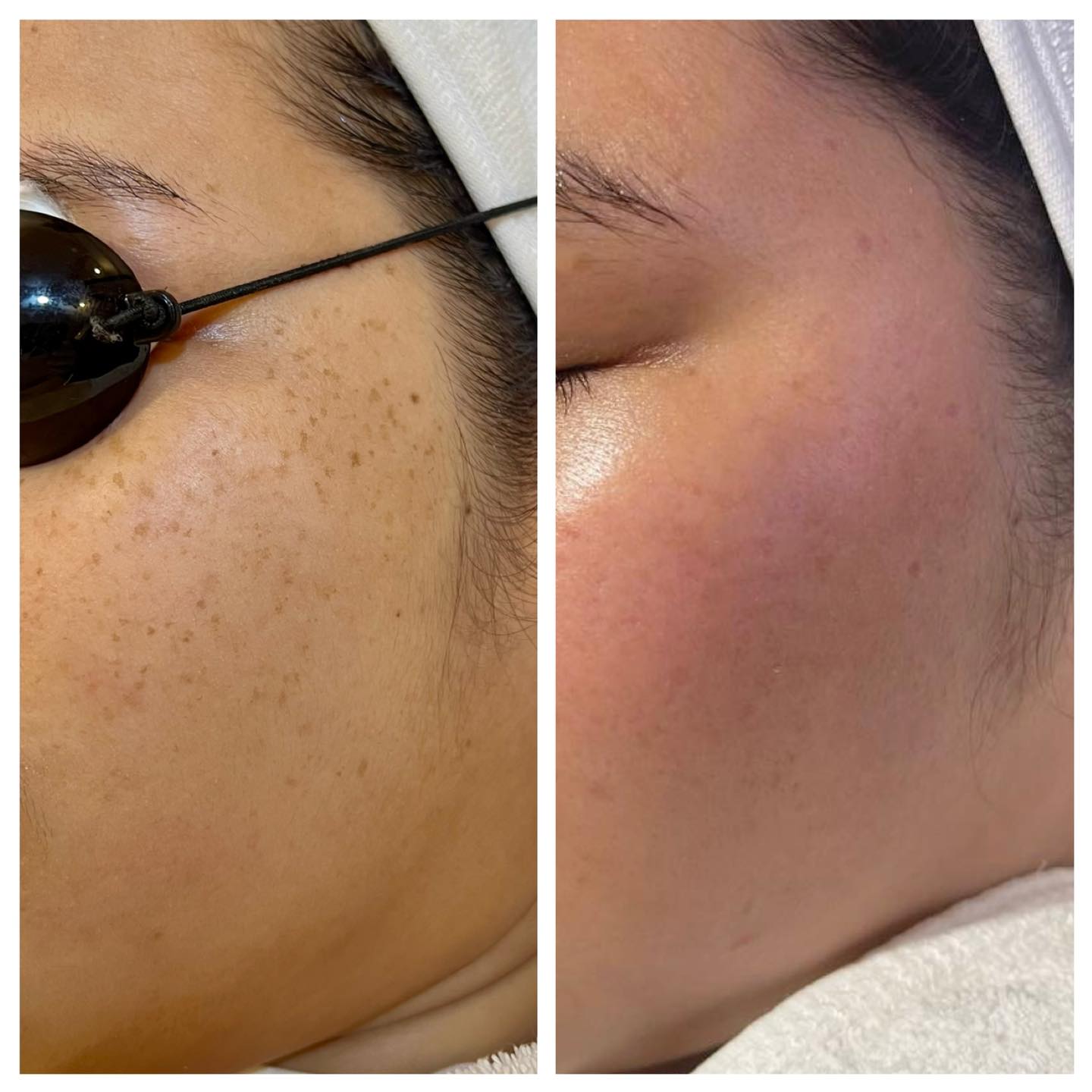Coreana Medical Aesthetics Facebook ad: ការព្យាបាលបំបាត់អាចម៍រុយដោយឡាស៊ែរ » ករណីនេះ គឺបាញ់តែម្តងគត់!