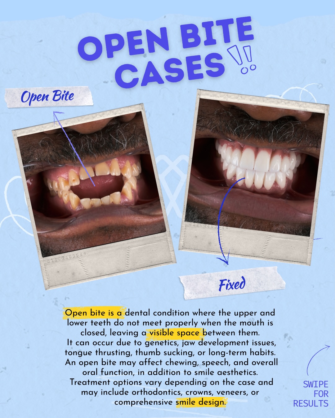 Prime Dental Turkey Facebook ad: An open bite is more than a gap…