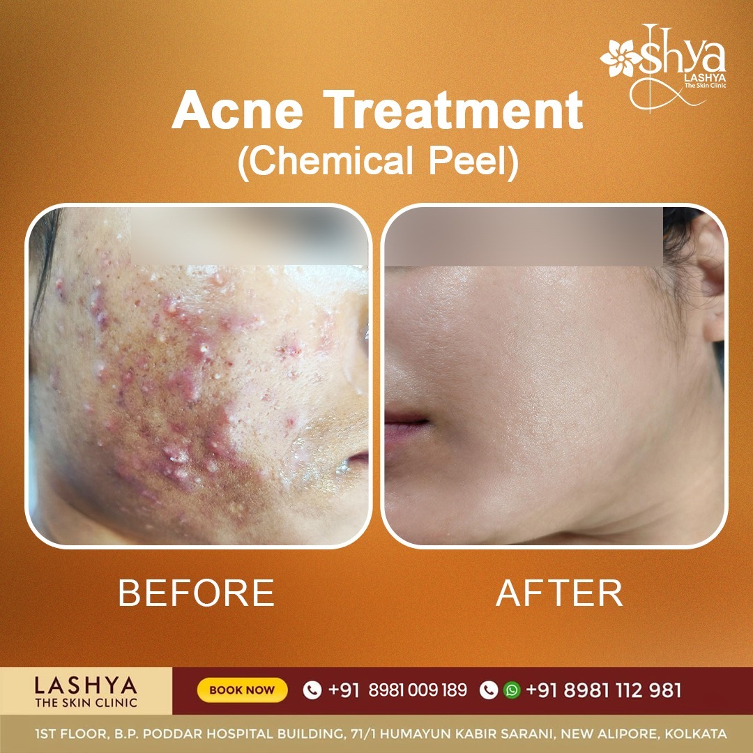 Lashya The Skin Clinic Facebook ad: Location: B.P. Poddar Hospital, New Alipore.