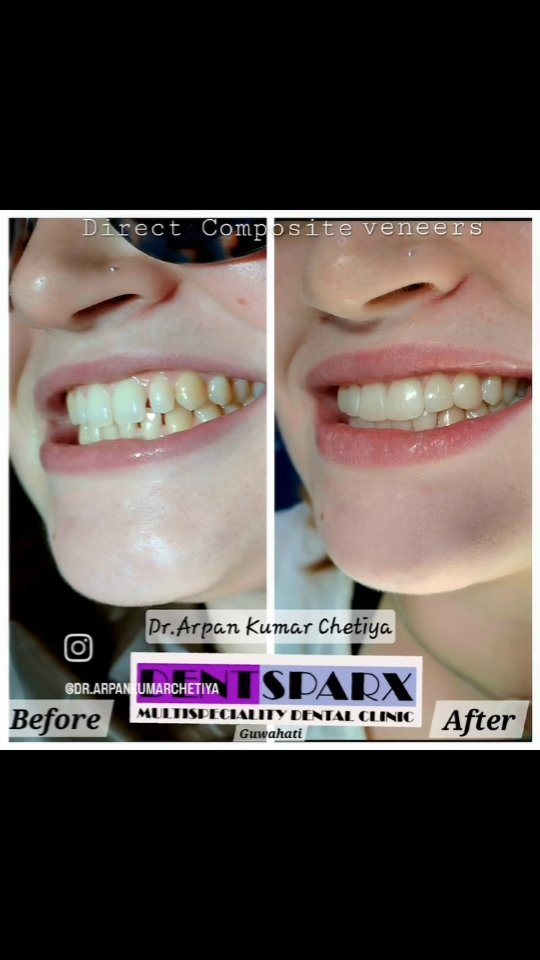 Dentsparx Multispeciality Dental Clinic,Guwahati Facebook ad: A case of direct composite veneers for teeth…