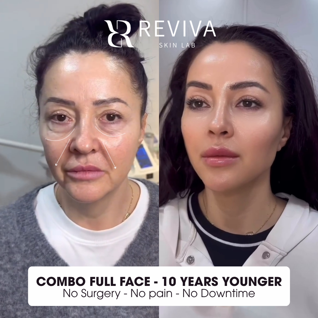 Reviva Skin Rejuvenation Institute - Iloilo City Facebook ad: Limited Time: 35% OFF for the First 10