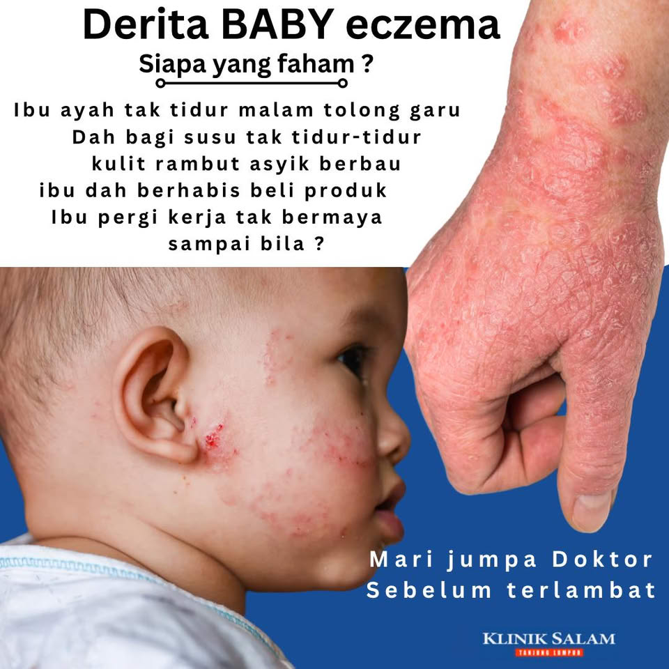 Klinik Salam Sungai Isap -Sebelah Texas Chicken Facebook ad: Apabila kulit eczema baby sudah berbau hanyir.