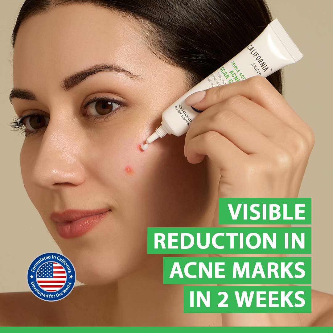 California Global Facebook ad: Acne goes away.