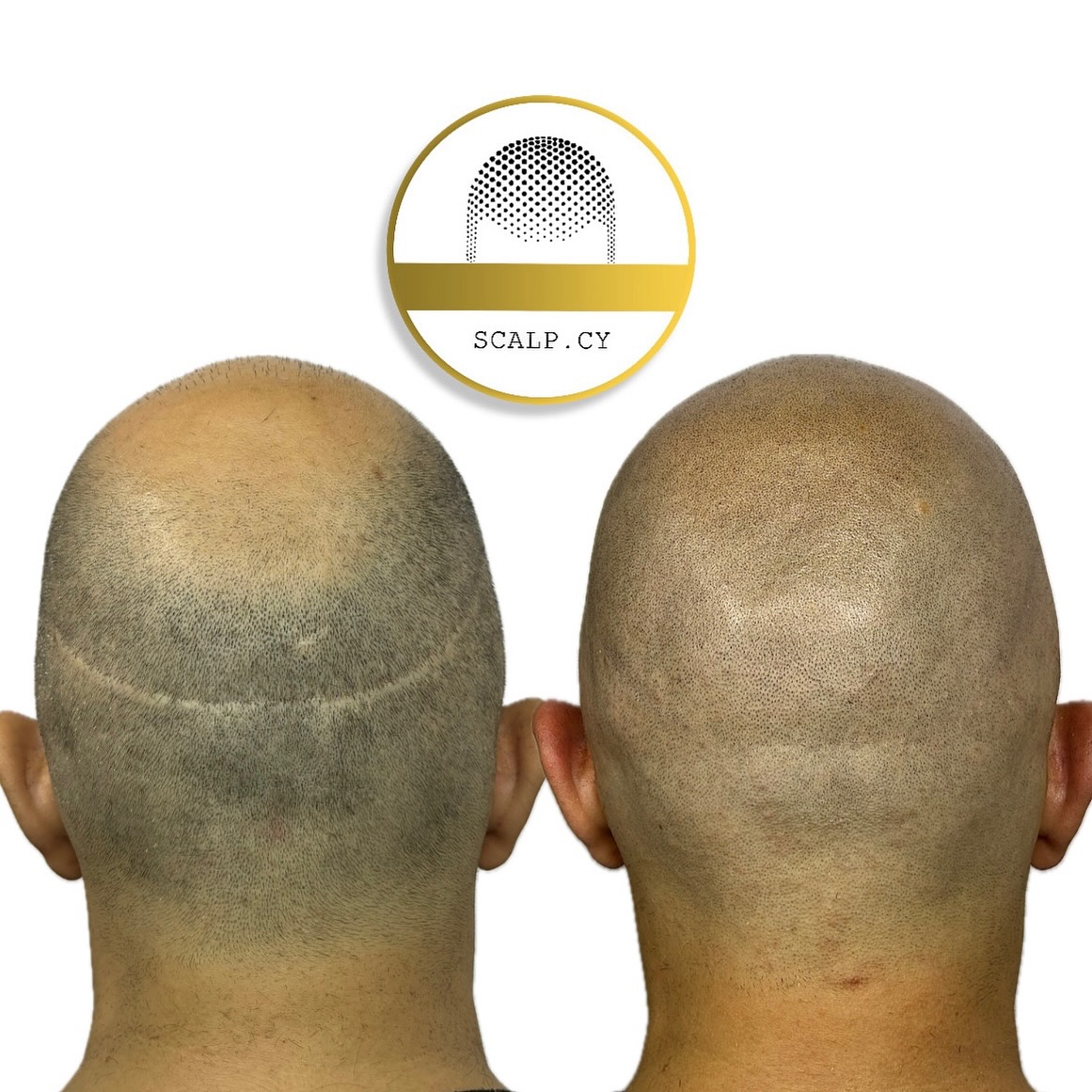 Scalp Micropigmentation Cyprus Facebook ad: FUT hair transplant scars disappeared with SMP