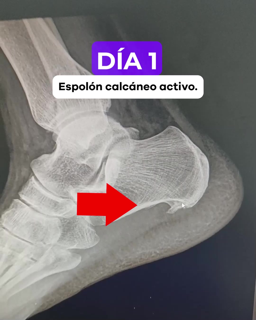 SereniVida Co Facebook ad: ¡Dile adiós al dolor del espolón calcáneo y…