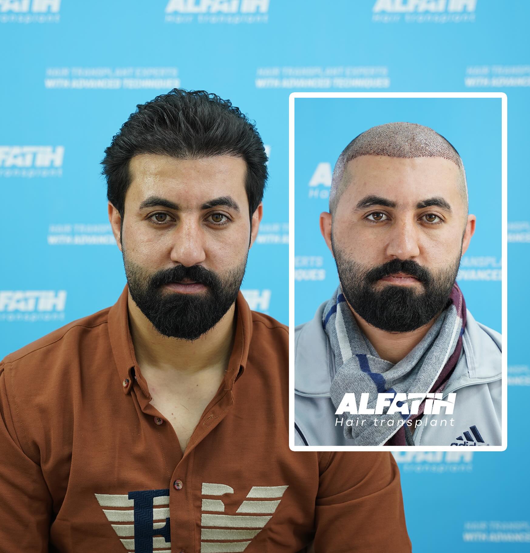 Al-fateh Hair Transplant. Facebook ad: في العراق نجري 300 عملية زراعة شعر شهريا