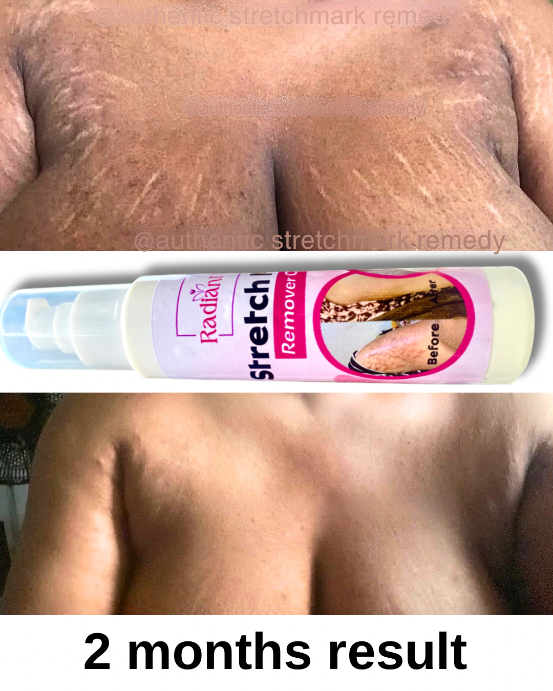 Radiant Skin Facebook ad: Clear stretch marks in just 30days