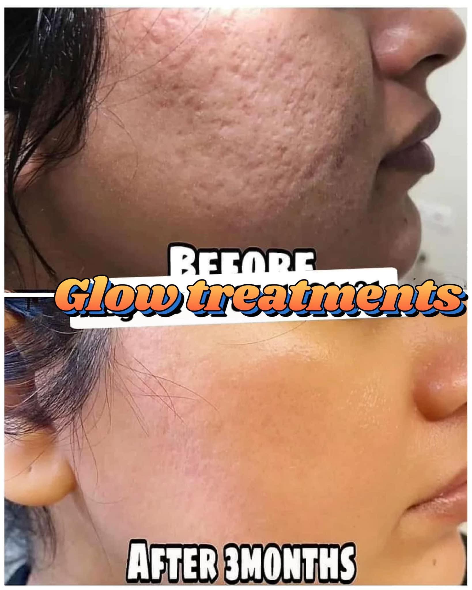 Glow Treatments Facebook ad: Glow Treatments එකත් එක්ක එකතු වෙලා skin එකේ…