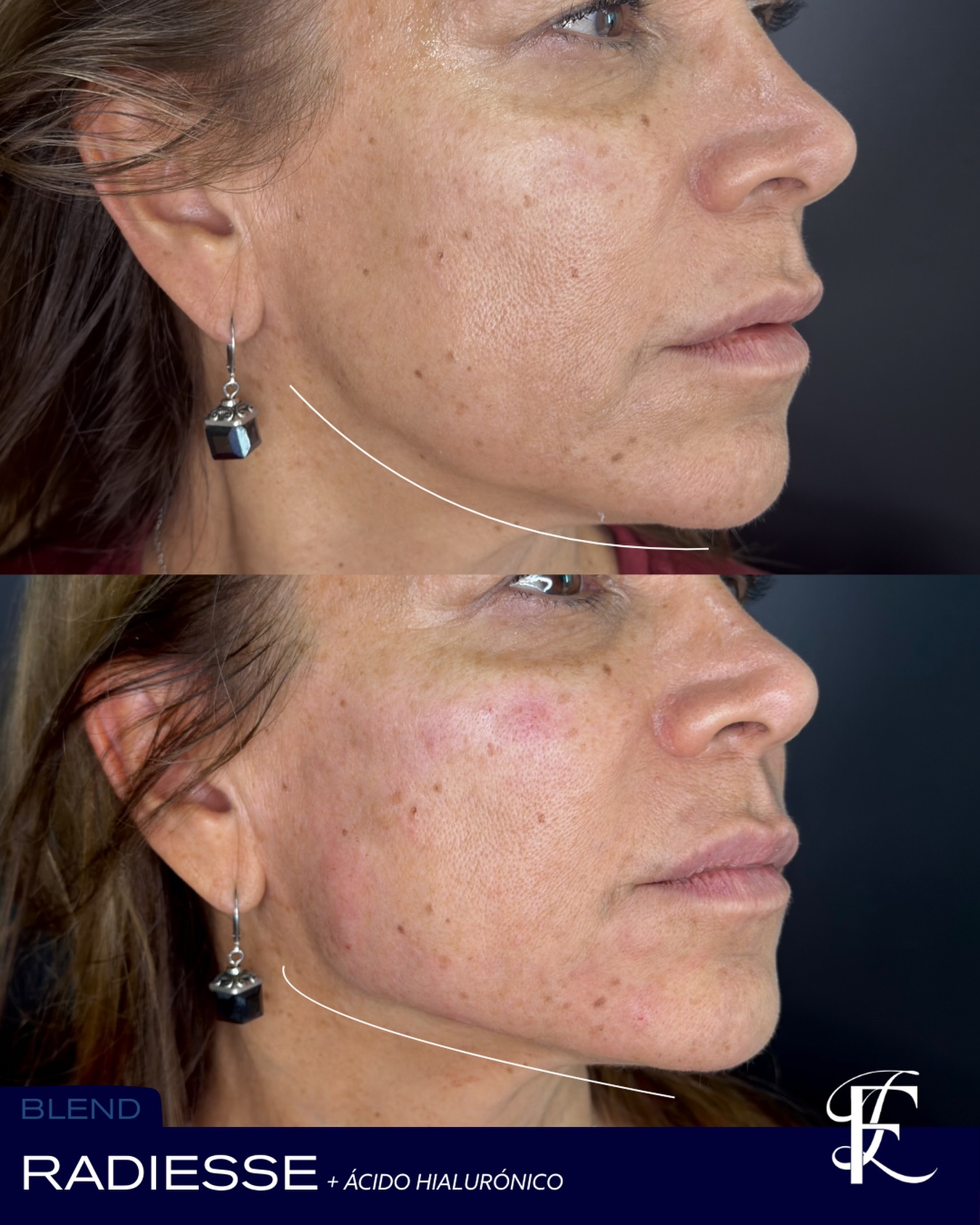 Dr Lautaro Franco Aesthetic Medicine Facebook ad: Otro caso de éxito con blend de Radiesse+…
