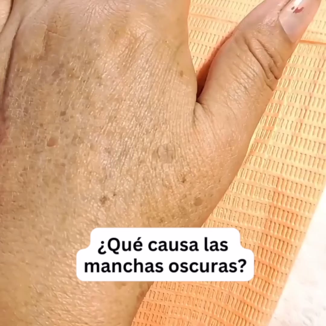 Miami MD Facebook ad: Cómo Detener las Manchas Oscuras Desde su Origen